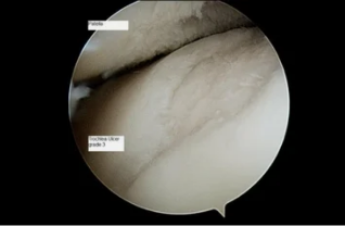 so astroscope in the knee joint osteoarthritis of the 3. grade