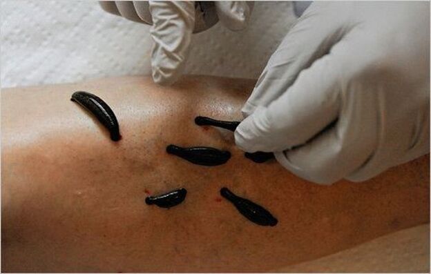 Treatment of knee osteoarthritis with leeches