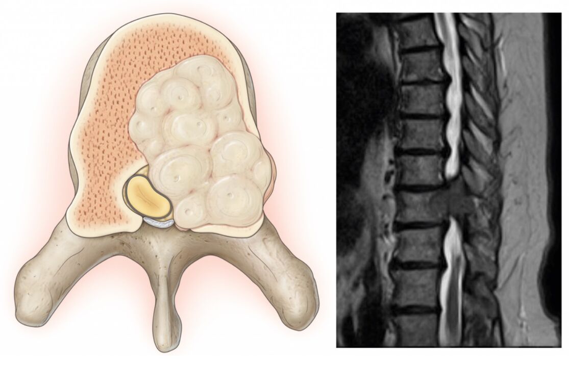 Swelling in the spine leading to back pain