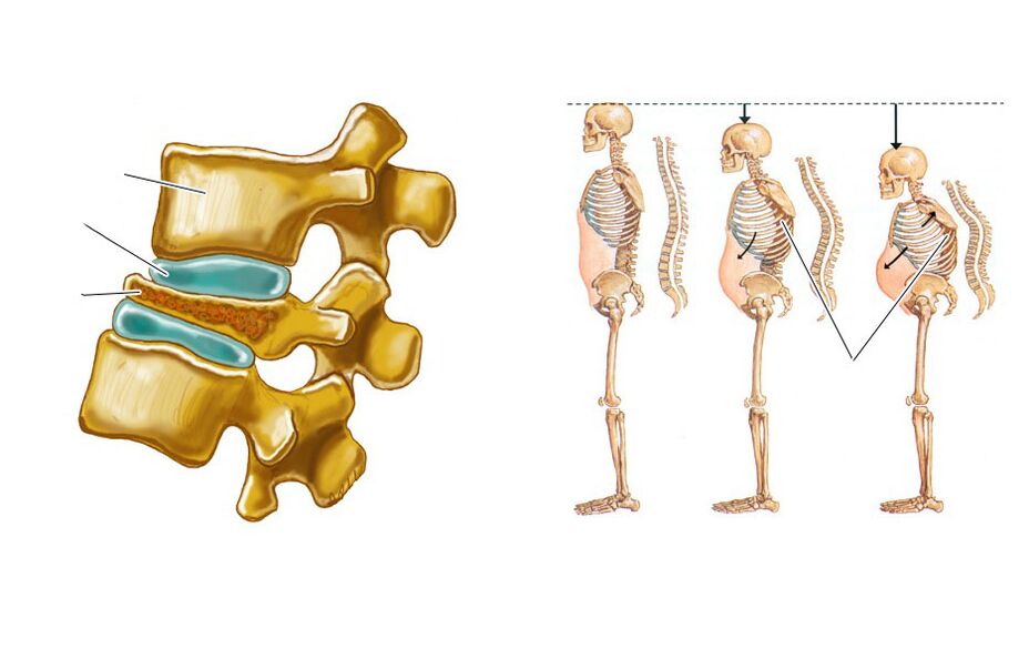 Swollen spine leads to back pain