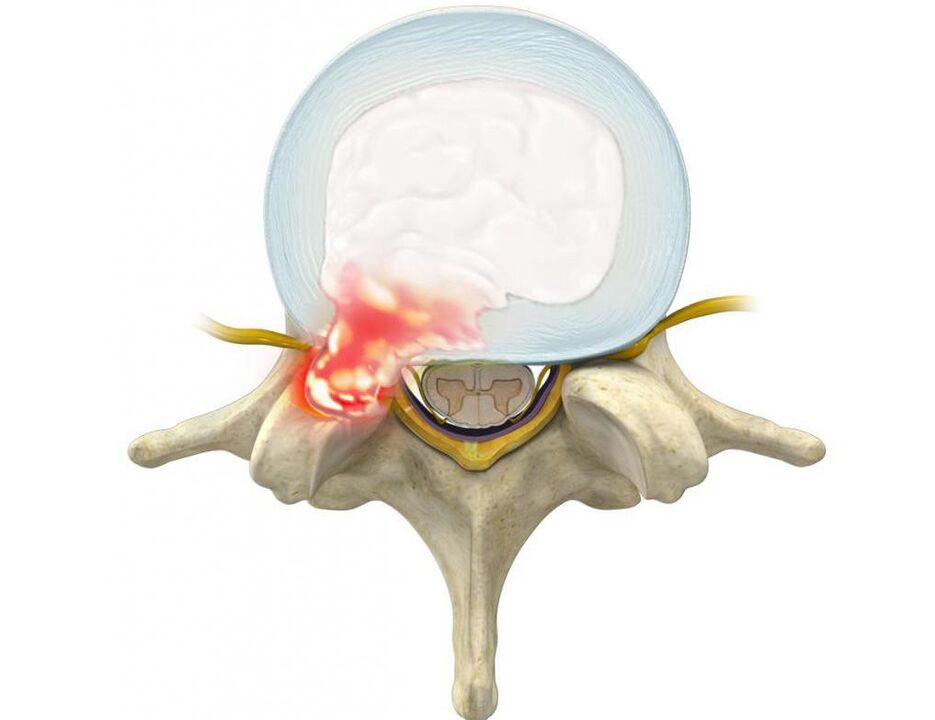 a damaged disc leads to back pain