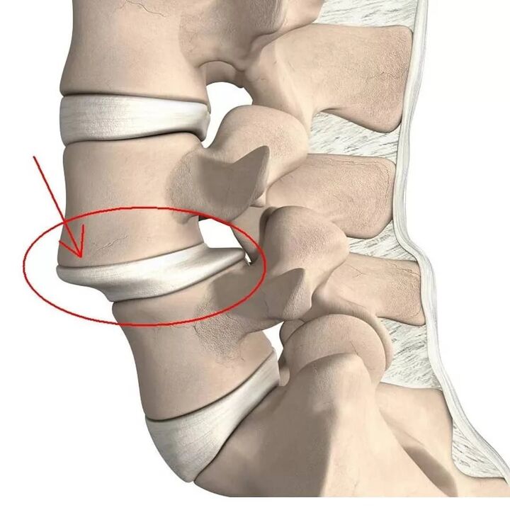 vertebrae injury