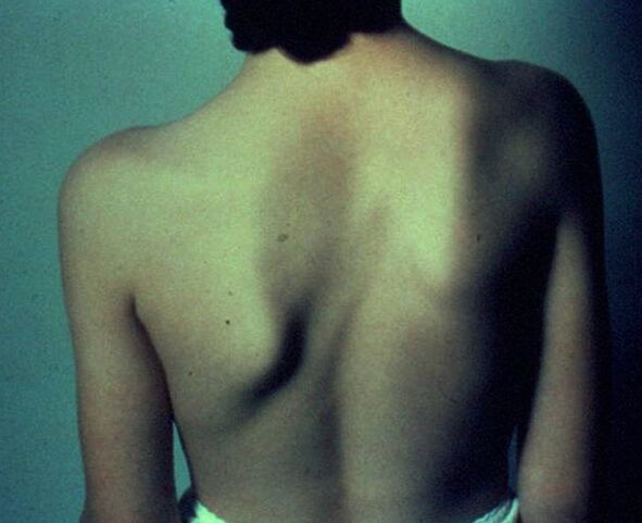 Sprengel disease is the cause of pain below the left shoulder blade