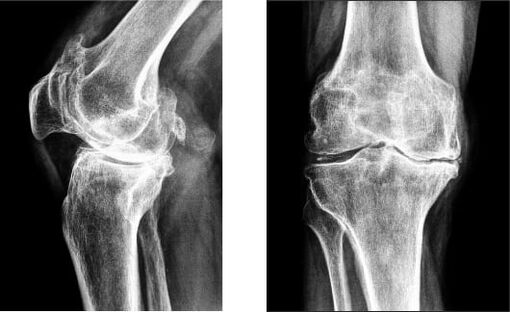 Knee gonarthrosis on X-ray film