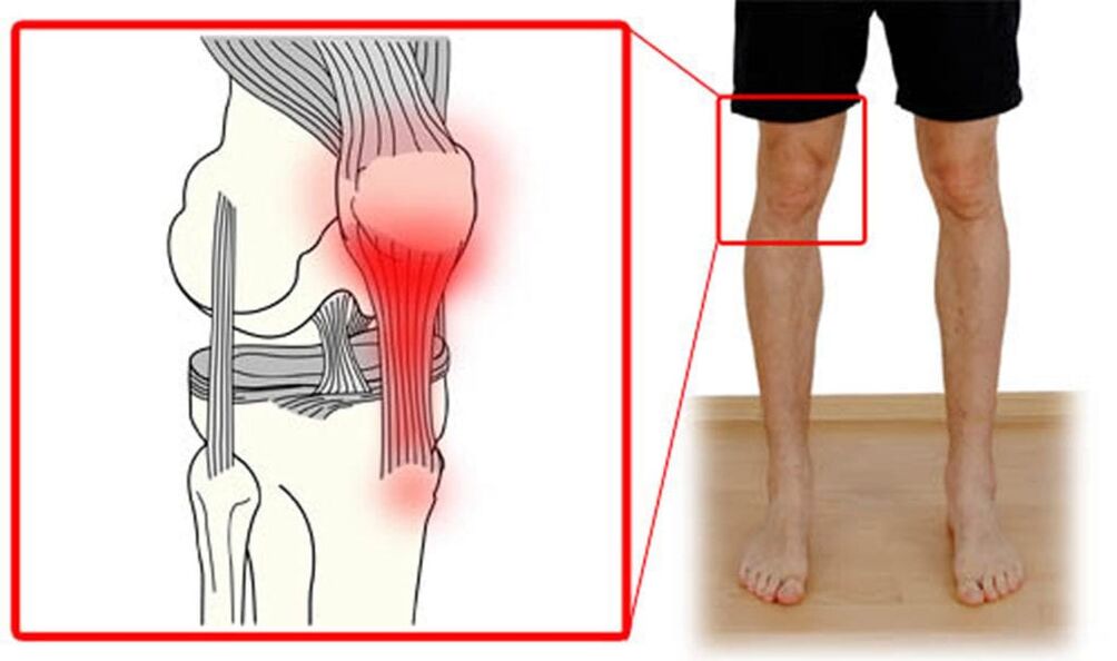 Tendonitis - inflammation of the tendon in the knee joint