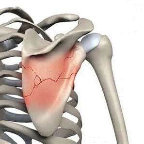 Shoulder blade fracture is one of the causes of severe pain