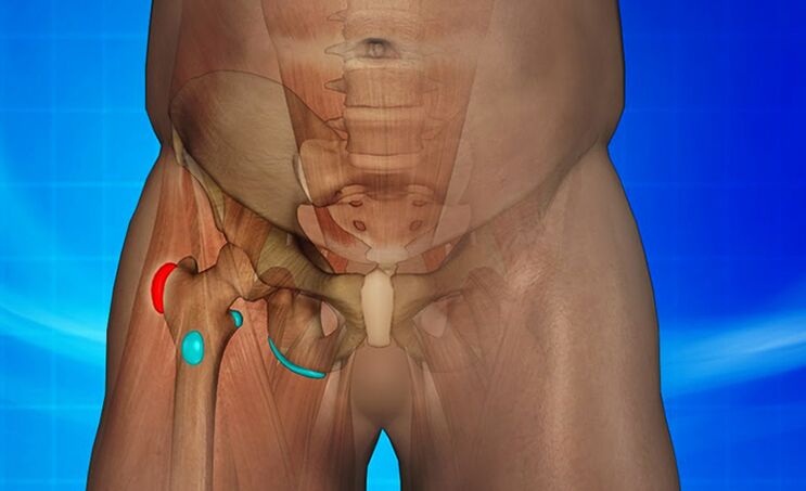 hip arthritis is the cause of pain