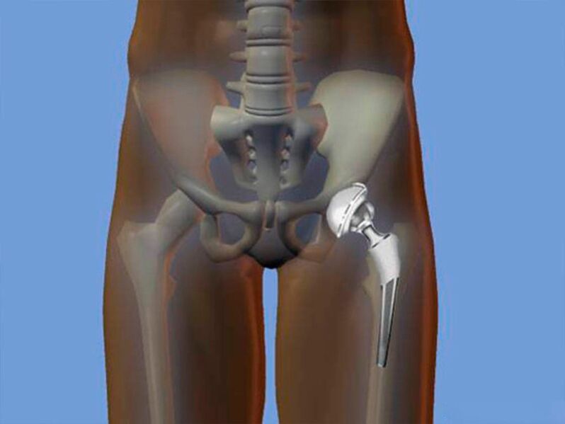 hip replacement for pain relief