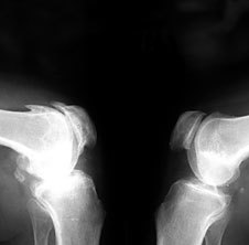 Osteoarthritis in the x-ray