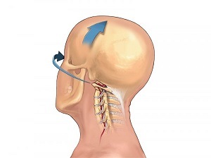 Manifestations of bone necrosis of the cervical spine