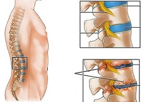 causes of lumbar spine necrosis