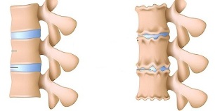 how to recognize the presence of lumbar spine necrosis