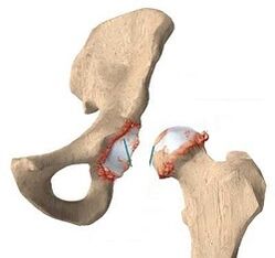 The cause of dry joints of the hip joints