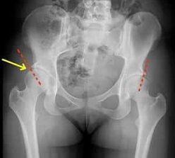 treatments for degenerative hip joints