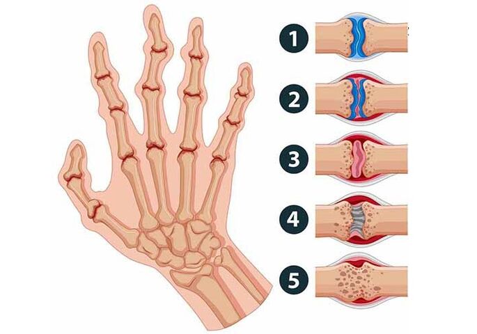 Developmental stages of arthritis of the finger joints