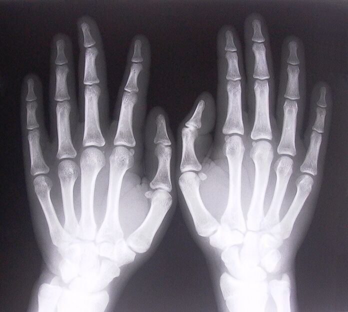 X-rays as a way to diagnose pain in the knuckles